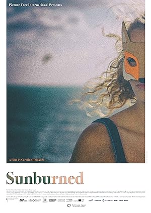 Sunburned